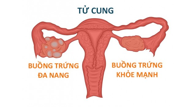 Giảm cân và Hội chứng buồng trứng đa nang (PCOS)